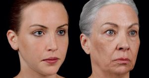 non-surgical facelift